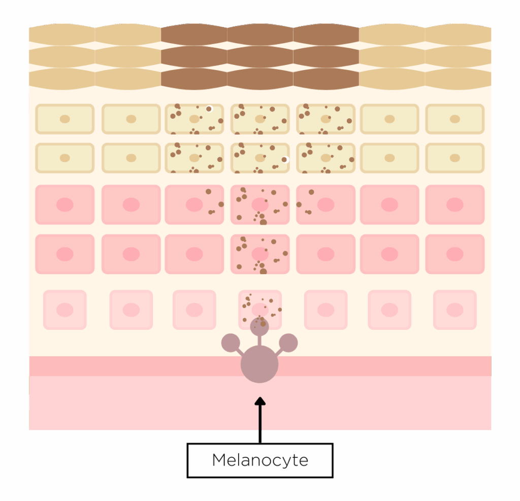 Artisan Melasma Diagram