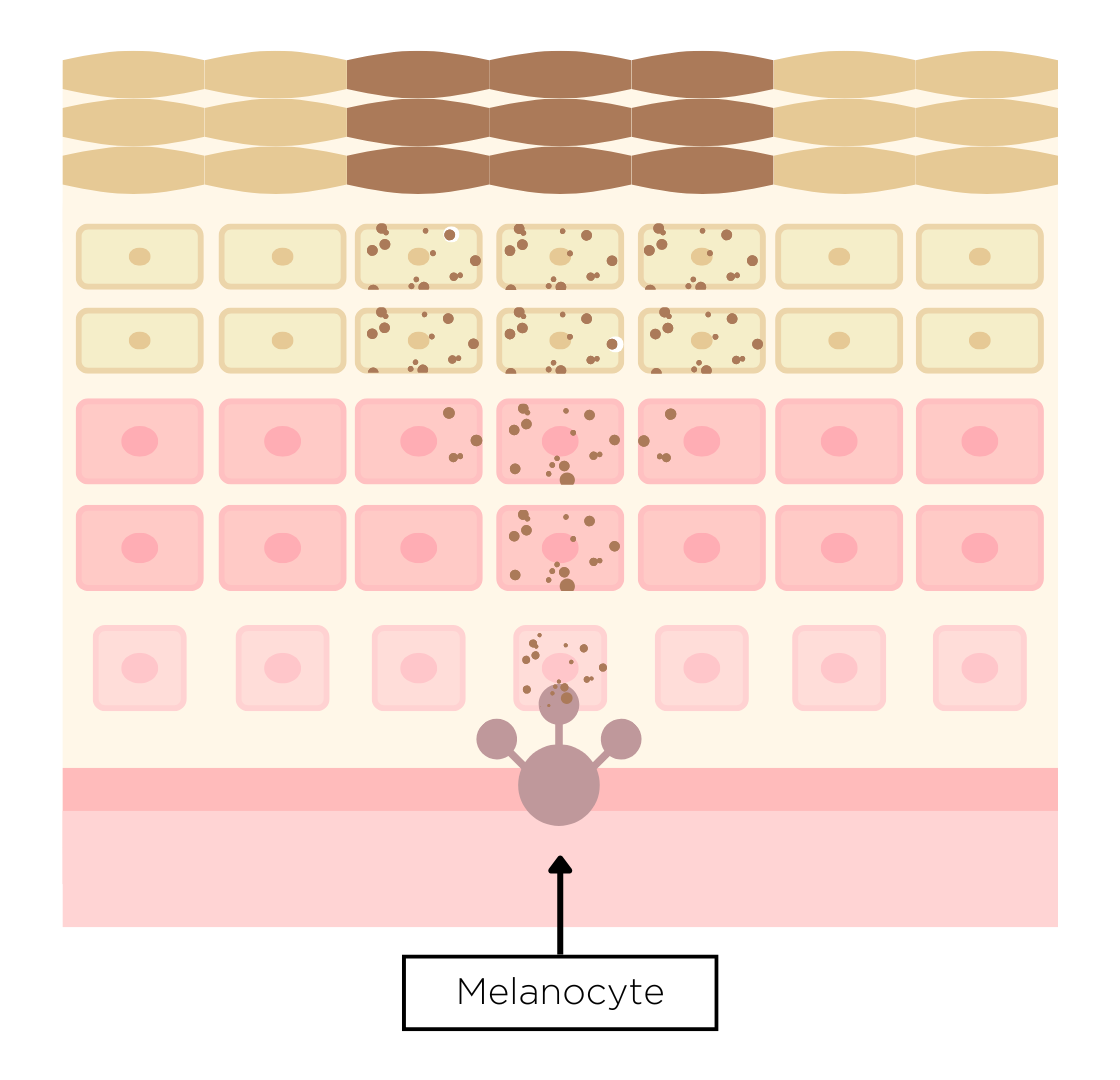 Understanding different forms of pigmentation: Melasma (facial pigmentation)